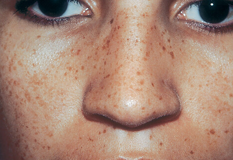 Lentigines | Long Island Dermatology